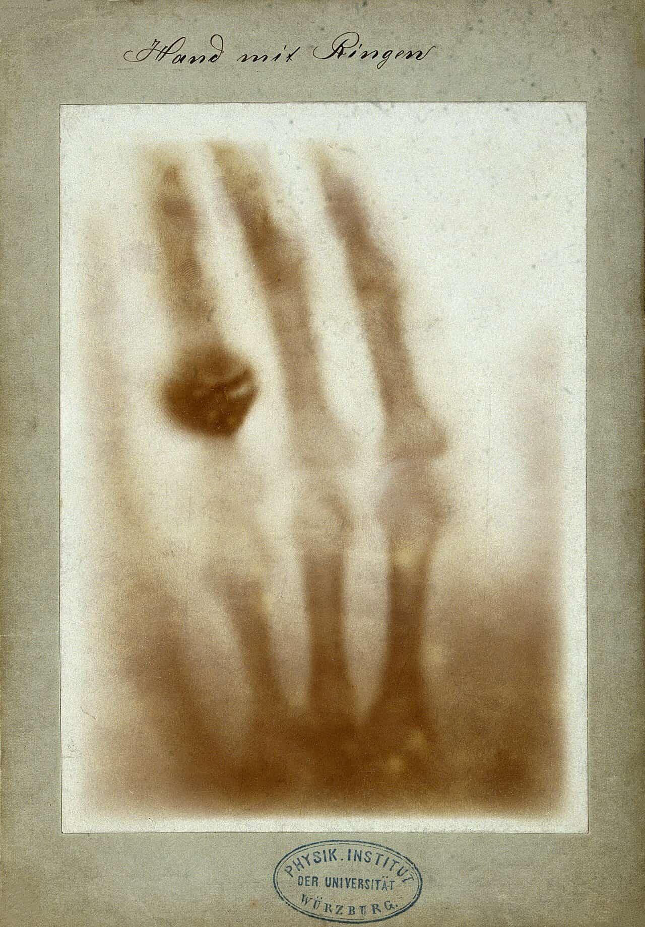 The first medical X-ray, of Anna Bertha Röntgen's hand, December 1895